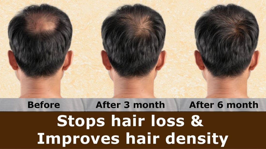 MINIBIS (Minoxidil 5%)