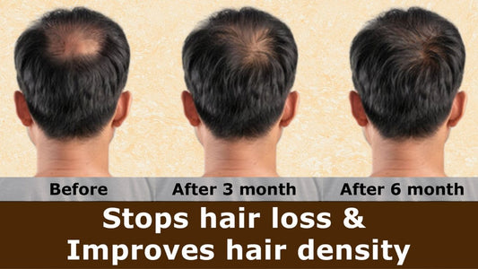 MINIBIS (Minoxidil 5%)