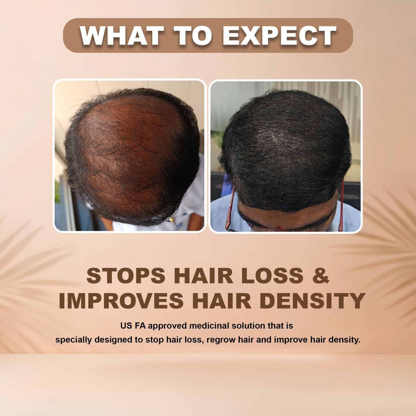 Minoxidil + DHT Shampoo Combo