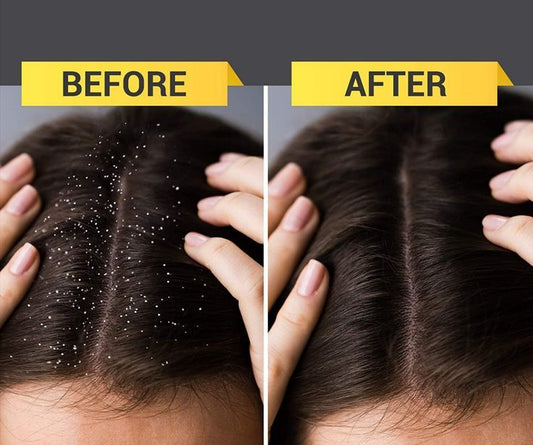 How to Choose the Right Anti-Dandruff Shampoo for Men