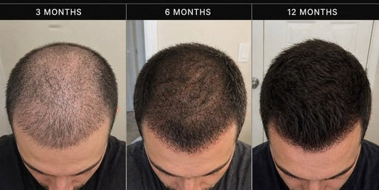 Minoxidil Mechanism of Action: How It Stimulates Hair Follicles