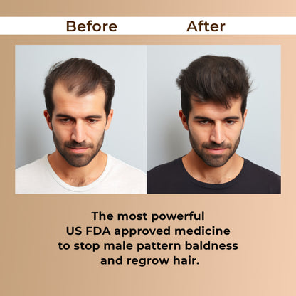 Finasteride 1mg | For Men