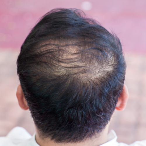 Hair Loss
