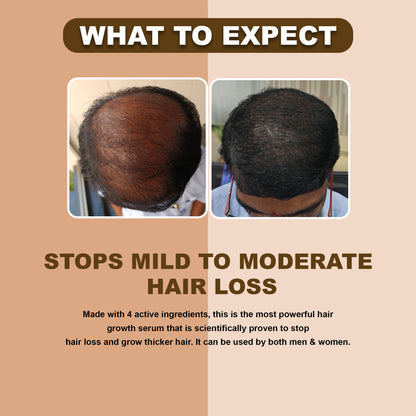 Minoxidil + Redensyl, Procapil and Biacapil Combo