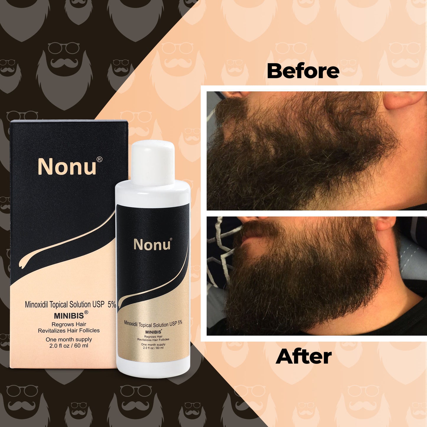 Minoxidil for Beard Growth