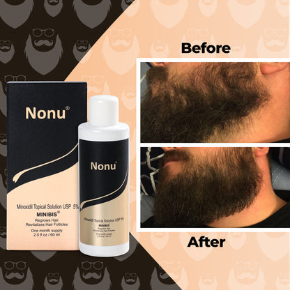 Minoxidil for Beard Growth