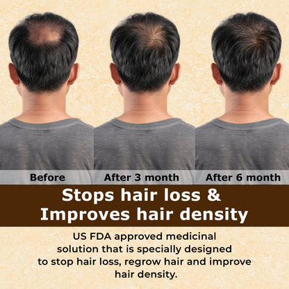 Minoxidil 5% | Alcohol Free with 2x Penetration Rate