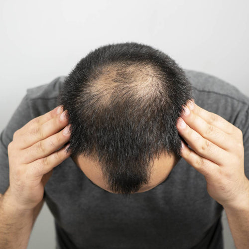 Top view of a man with visible crown baldness and thinning hair illustrating male pattern hair loss.