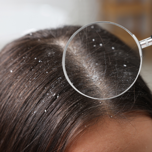 Dandruff